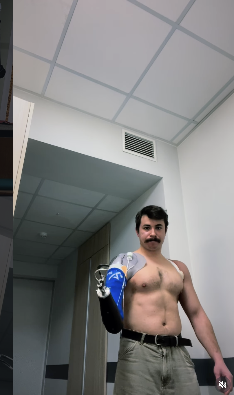 "Не пугайтесь": сын Грубича показался с механическим протезом на руке (фото)